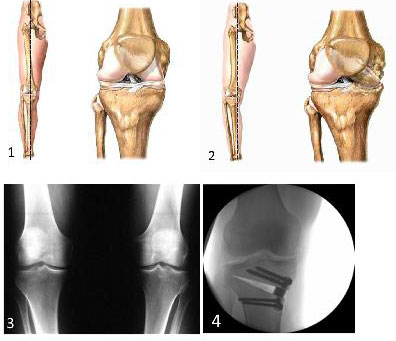 blokada boli u zglobu koljena zglobovi i mišići uzrokuju liječenje